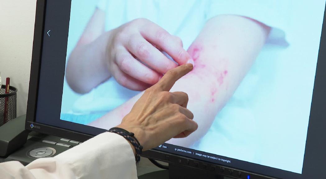 Dermatitis atòpica, una malaltia amb incidència alta al Principat 