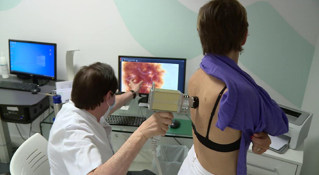 Reportatge: revisar la pell i protegir-se per prevenir el melanoma